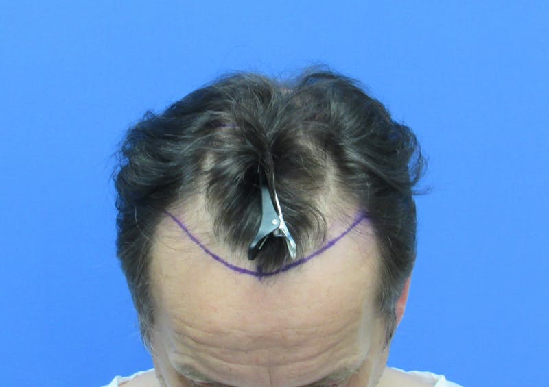 Male Hair Transplant Before & After Gallery - Patient 215895 - Image 2