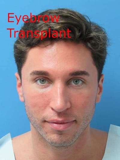 LP Hair Transplant Before & After Gallery - Patient 426155 - Image 1