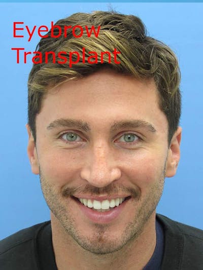 LP Hair Transplant Before & After Gallery - Patient 426155 - Image 2