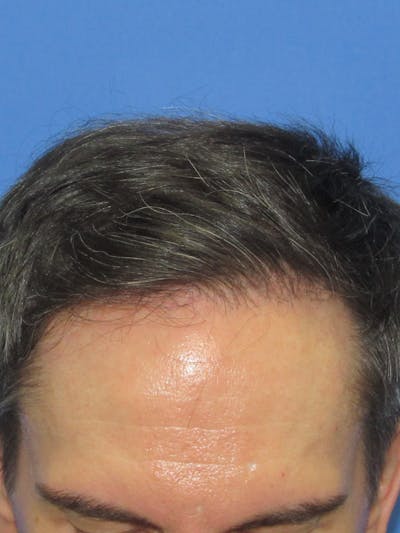 LP Hair Transplant Before & After Gallery - Patient 723089 - Image 1
