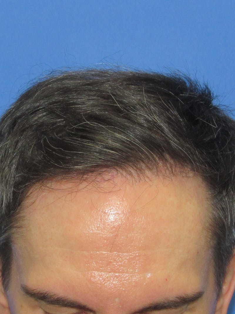 LP Hair Transplant Before & After Gallery - Patient 723089 - Image 1