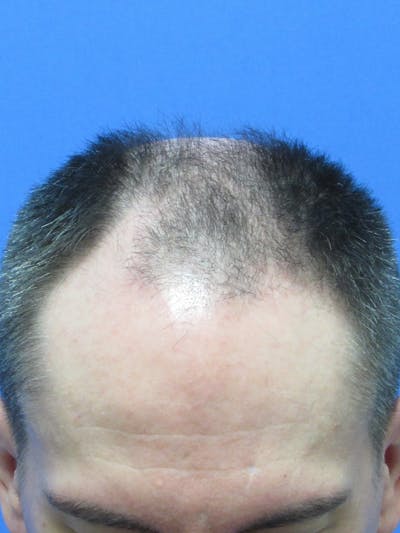 LP Hair Transplant Before & After Gallery - Patient 723089 - Image 2