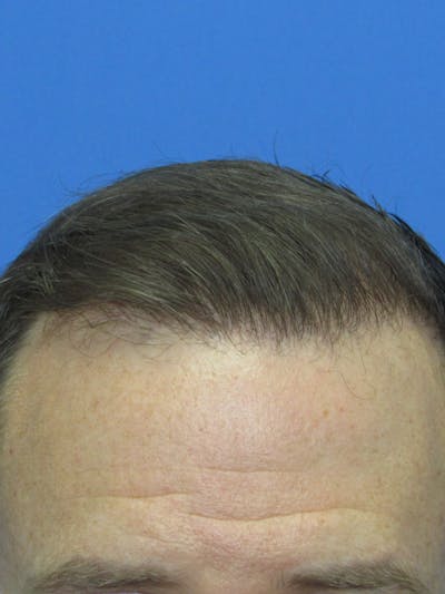 LP Hair Transplant Before & After Gallery - Patient 341755 - Image 1