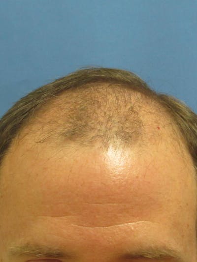 LP Hair Transplant Before & After Gallery - Patient 341755 - Image 2