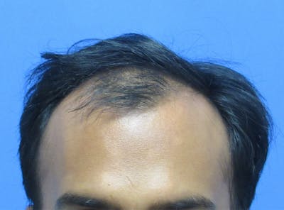 Male Hair Transplant Before & After Gallery - Patient 821343 - Image 1