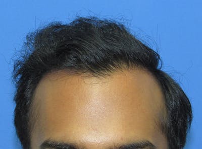 Male Hair Transplant Before & After Gallery - Patient 821343 - Image 2