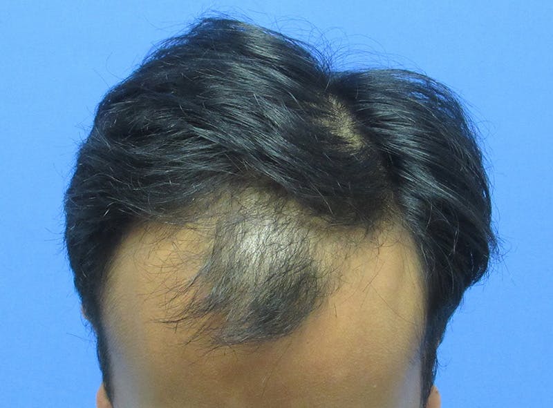 Male Hair Transplant Before & After Gallery - Patient 821343 - Image 3