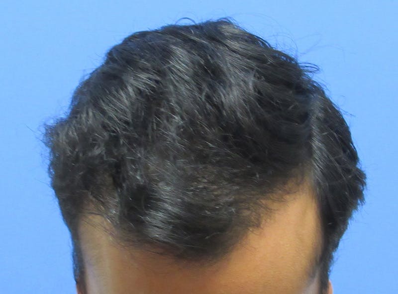 Male Hair Transplant Before & After Gallery - Patient 821343 - Image 4