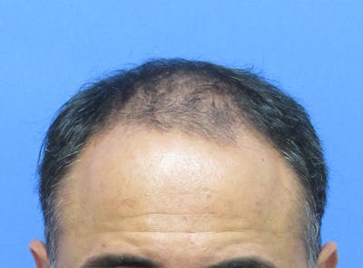 Male Hair Transplant Before & After Gallery - Patient 236214 - Image 1