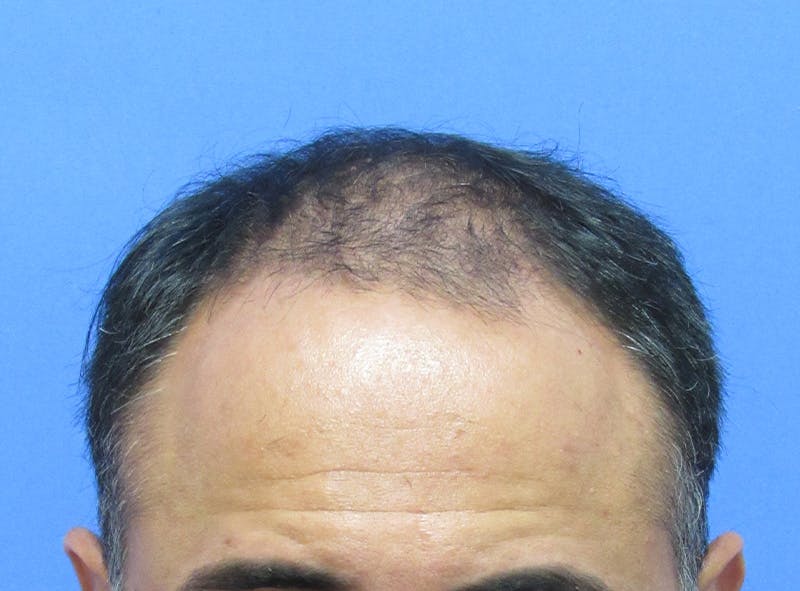 Male Hair Transplant Before & After Gallery - Patient 236214 - Image 1
