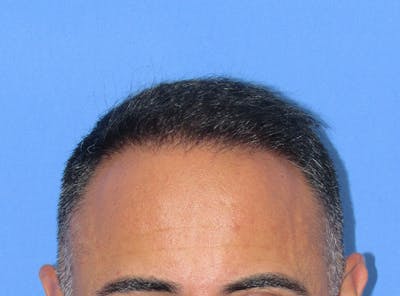 Male Hair Transplant Before & After Gallery - Patient 236214 - Image 2