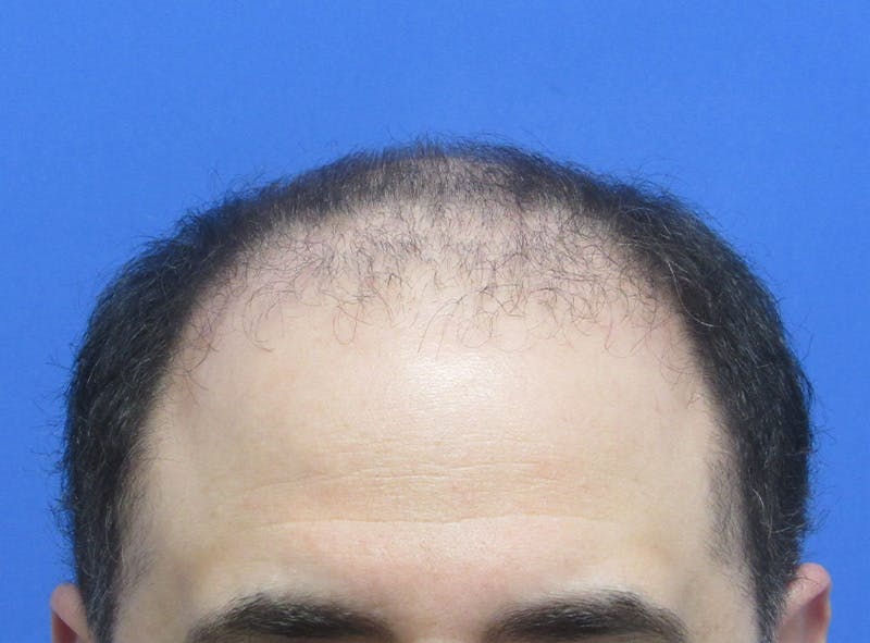 Male Hair Transplant Before & After Gallery - Patient 136412 - Image 1