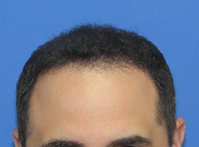 Male Hair Transplant Before & After Gallery - Patient 136412 - Image 2