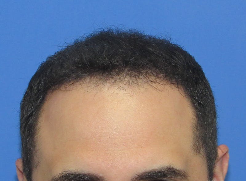 Male Hair Transplant Before & After Gallery - Patient 136412 - Image 2