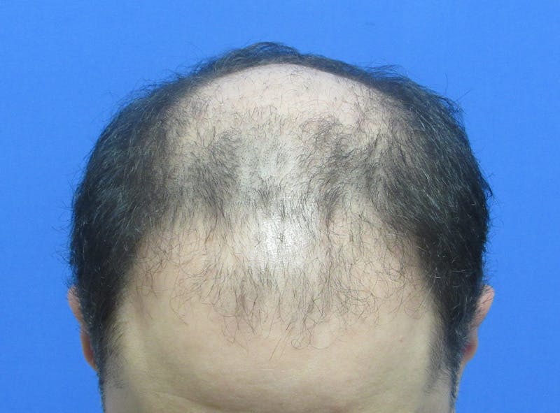 Male Hair Transplant Before & After Gallery - Patient 136412 - Image 3