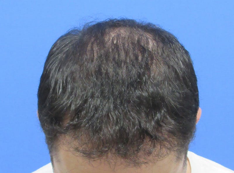 Male Hair Transplant Before & After Gallery - Patient 136412 - Image 4