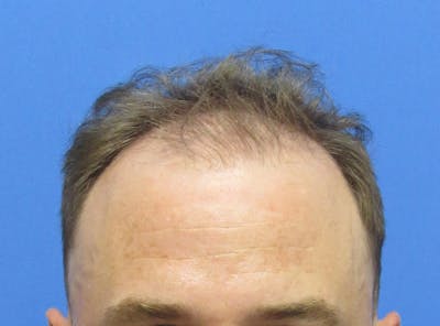 Male Hair Transplant Before & After Gallery - Patient 331308 - Image 1