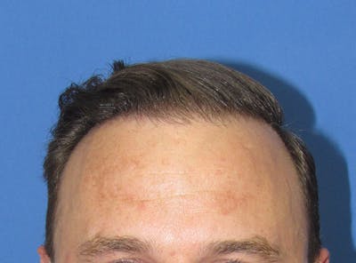 Male Hair Transplant Before & After Gallery - Patient 331308 - Image 2