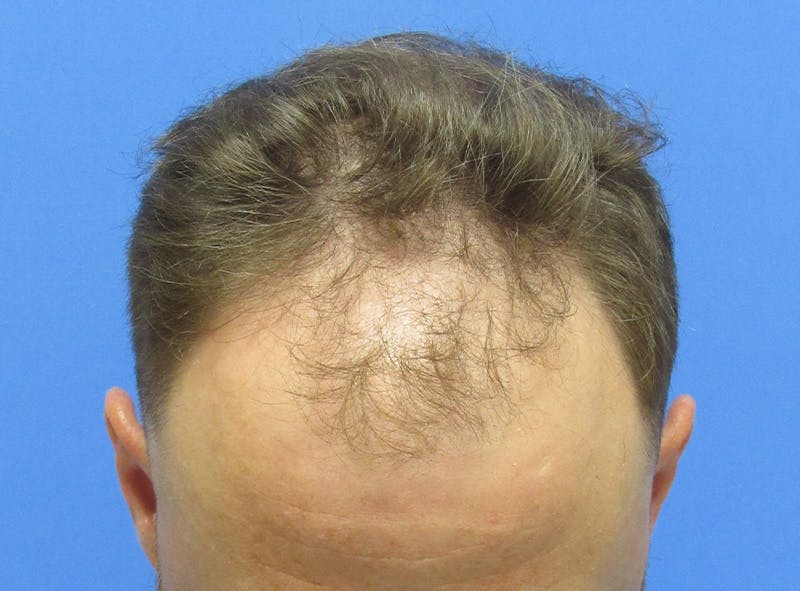 Male Hair Transplant Before & After Gallery - Patient 331308 - Image 3