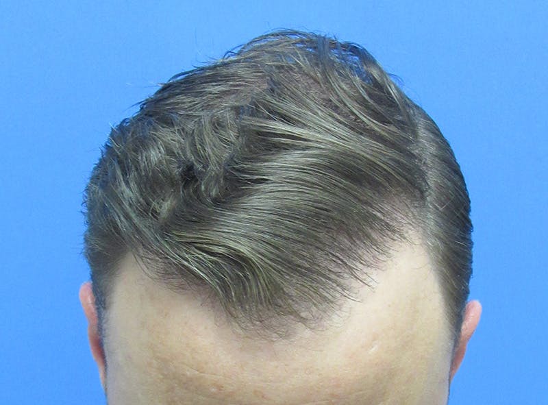 Male Hair Transplant Before & After Gallery - Patient 331308 - Image 4