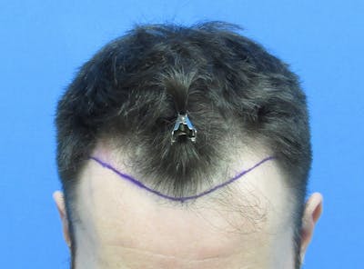 Male Hair Transplant Before & After Gallery - Patient 589389 - Image 1