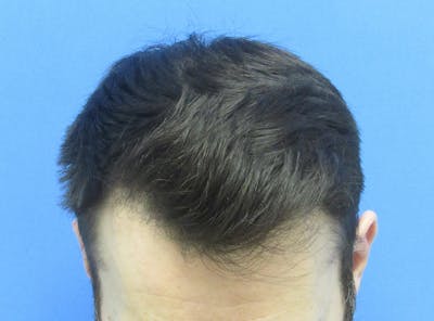 Male Hair Transplant Before & After Gallery - Patient 589389 - Image 2
