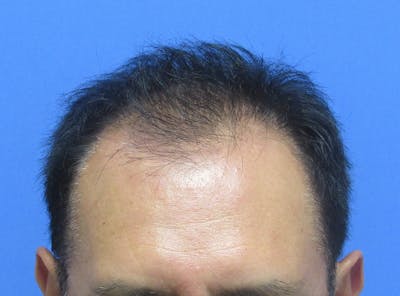 Male Hair Transplant Before & After Gallery - Patient 148636 - Image 1