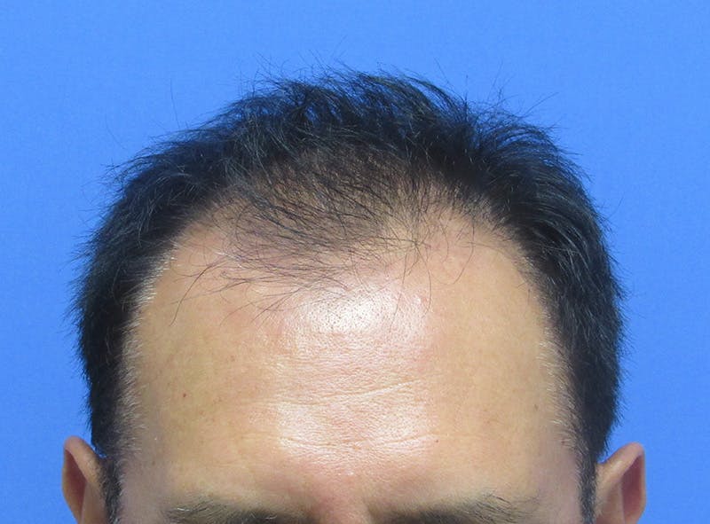 Male Hair Transplant Before & After Gallery - Patient 148636 - Image 1