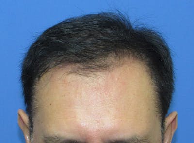 Male Hair Transplant Before & After Gallery - Patient 148636 - Image 2