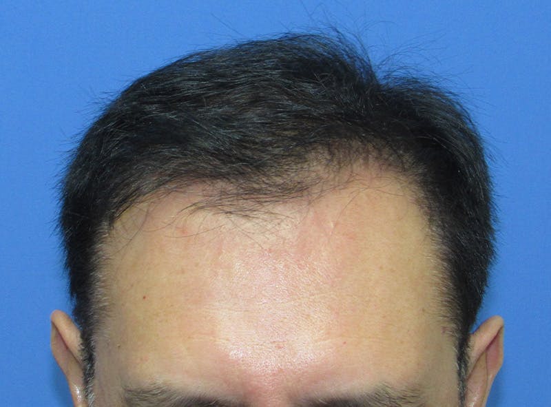 Male Hair Transplant Before & After Gallery - Patient 148636 - Image 2