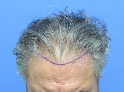 Male Hair Transplant Before & After Gallery - Patient 863374 - Image 1
