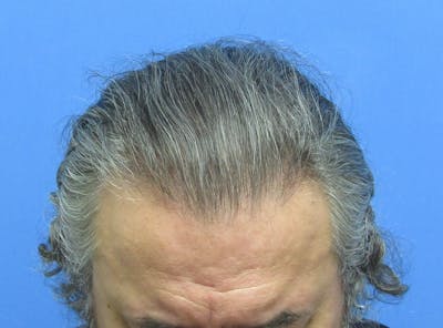 Male Hair Transplant Before & After Gallery - Patient 863374 - Image 2