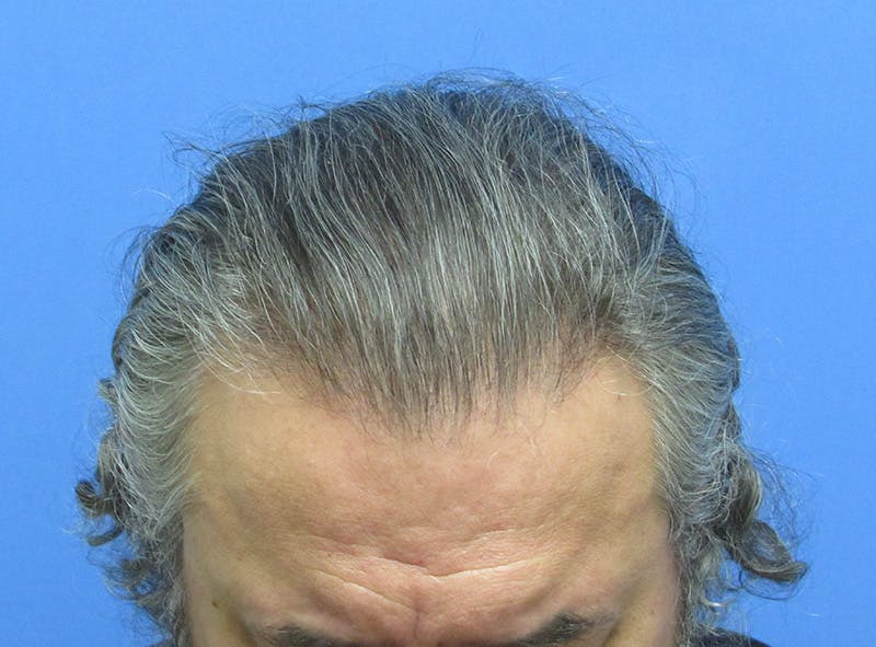Male Hair Transplant Before & After Gallery - Patient 863374 - Image 2