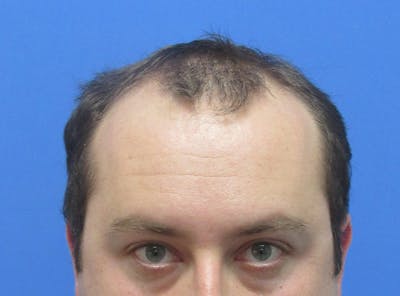 Male Hair Transplant Before & After Gallery - Patient 132266 - Image 1