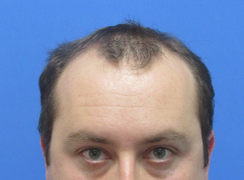 Male Hair Transplant Before & After Gallery - Patient 132266 - Image 1