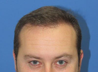 Male Hair Transplant Before & After Gallery - Patient 132266 - Image 2