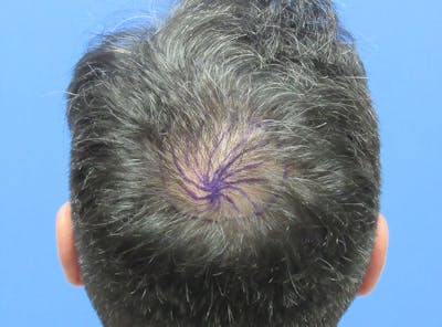 Male Hair Transplant Before & After Gallery - Patient 259967 - Image 1