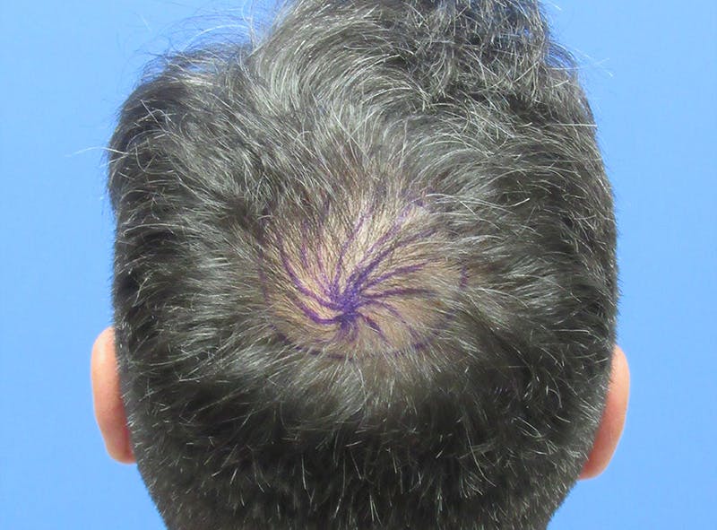 Male Hair Transplant Before & After Gallery - Patient 259967 - Image 1