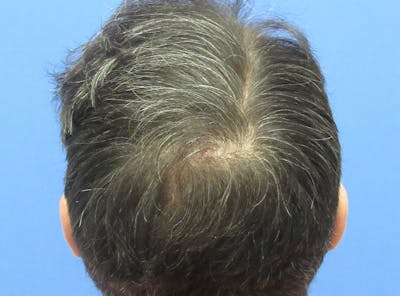 Male Hair Transplant Before & After Gallery - Patient 259967 - Image 2