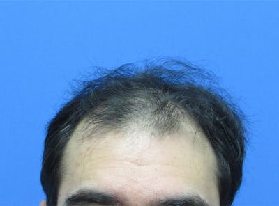 Male Hair Transplant Before & After Gallery - Patient 413197 - Image 1