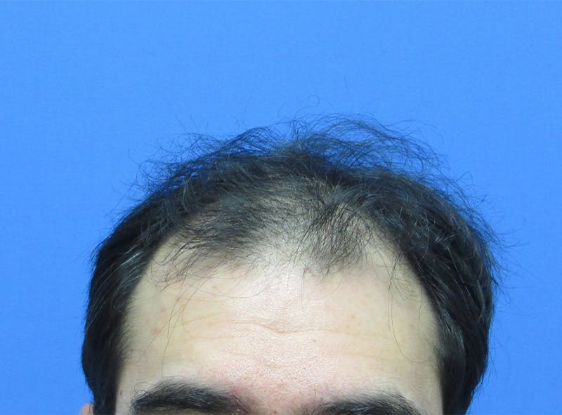 Male Hair Transplant Before & After Gallery - Patient 413197 - Image 1