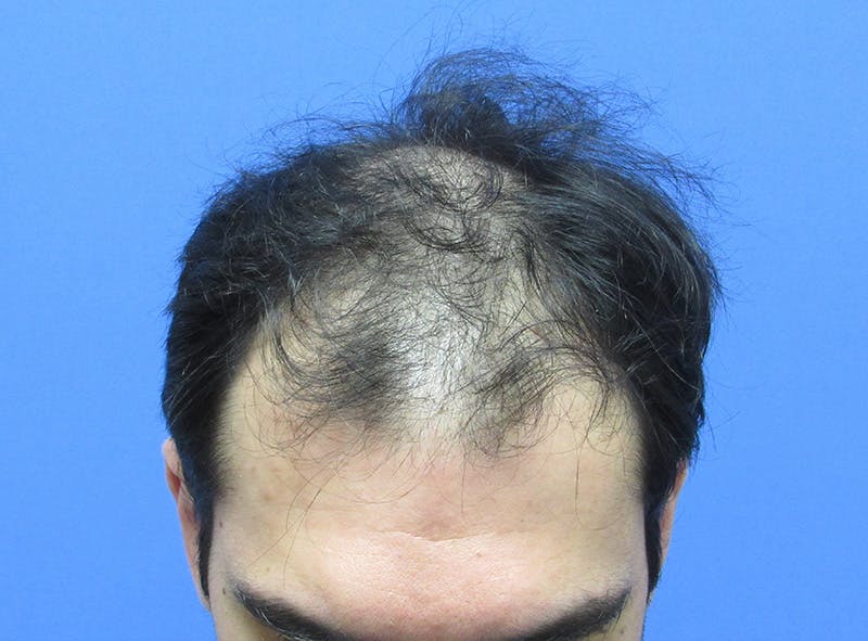 Male Hair Transplant Before & After Gallery - Patient 413197 - Image 3