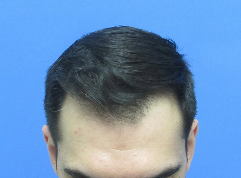 Male Hair Transplant Before & After Gallery - Patient 413197 - Image 4