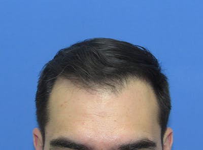 Male Hair Transplant Before & After Gallery - Patient 413197 - Image 2