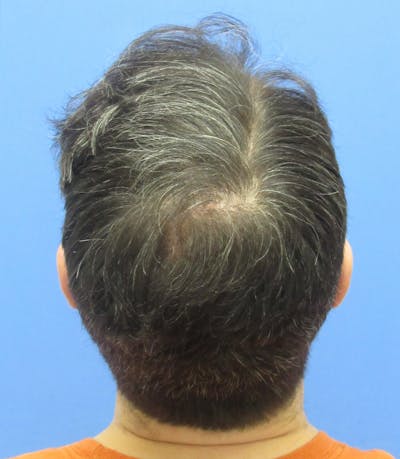 Male Hair Transplant Before & After Gallery - Patient 259967 - Image 2