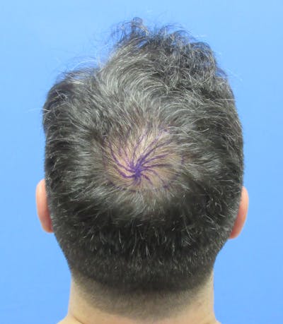 Male Hair Transplant Before & After Gallery - Patient 259967 - Image 1