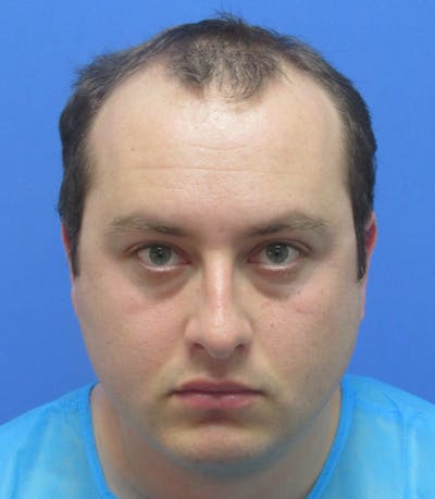 Male Hair Transplant Before & After Gallery - Patient 132266 - Image 1