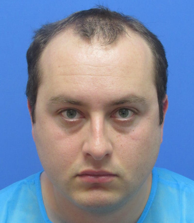 Male Hair Transplant Before & After Gallery - Patient 132266 - Image 1