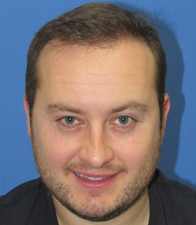 Male Hair Transplant Before & After Gallery - Patient 132266 - Image 2