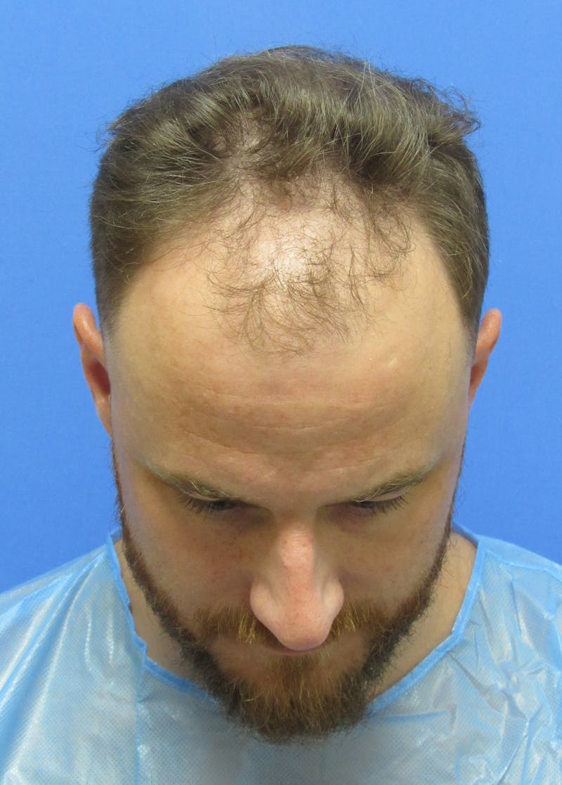 Male Hair Transplant Before & After Gallery - Patient 331308 - Image 3
